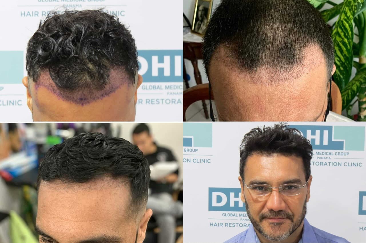 What Makes Westminster Medical Group® the Top Hair Transplant London Clinic
