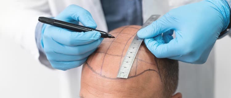 Hair Transplant Turkey: Expert Care from Start to Finish